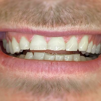 Dental Bonding - Smile 5 before